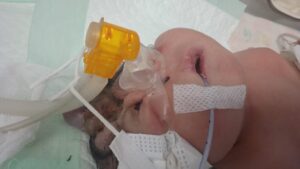 Butuh Bantuan Dermawan, Bayi Perempuan di Palembang Tidak Ada Tempurung Kepala